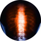 spinal tumor circle