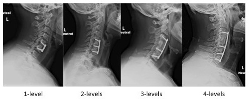 anterior cervical discectomy and fusion 1
