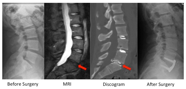 anterior lumbar interbody fusion 1