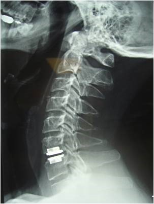 artificial cervical disc replacement 2