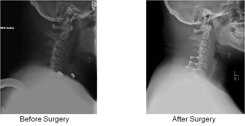 cervical laminoplasty 3