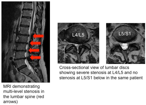 lumbar laminotomy laminectomy 1