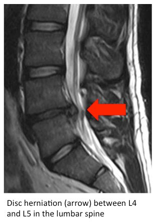 microdiscectomy 1