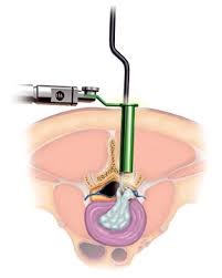 microdiscectomy 2