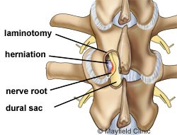 microdiscectomy 3