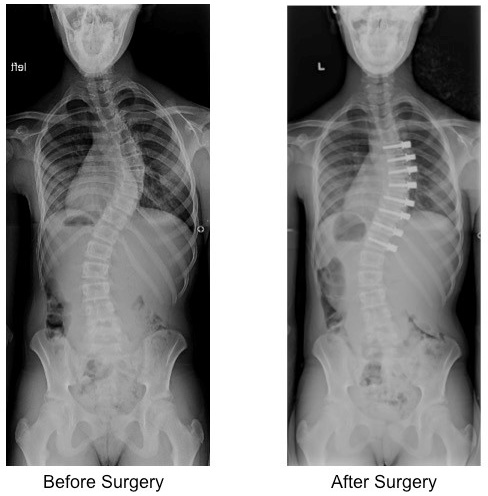 minimally invasive fusionless surgery for ais 1