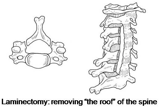 posterior cervical laminectomy and instrumented fusion 1