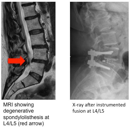 posterior lumbar spinal instrumented fusion 1