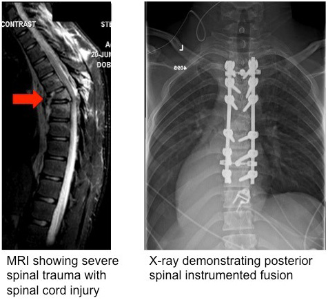 posterior spinal instrumented fusion 1