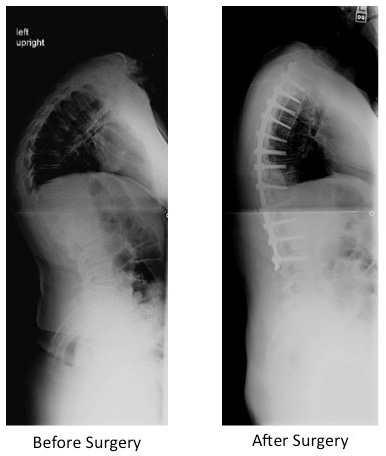 posterior spinal instrumented fusion for adult kyphosis 1