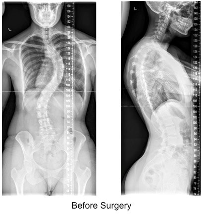 posterior spinal instrumented fusion for adult scoliosis 1