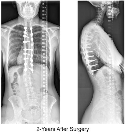 posterior spinal instrumented fusion for adult scoliosis 2