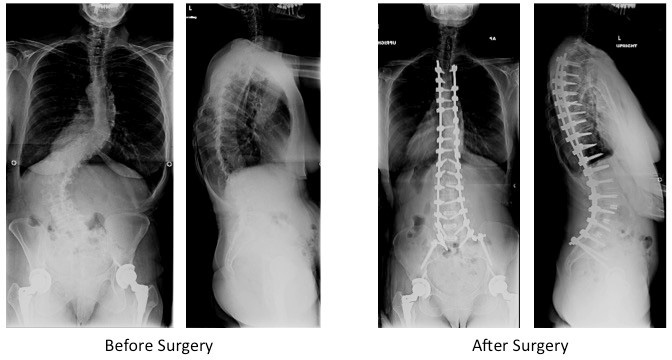 posterior spinal instrumented fusion for adult scoliosis 3