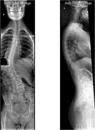 posterior spinal instrumented fusion for ais 1