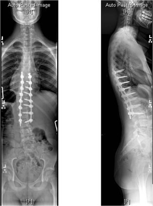 posterior spinal instrumented fusion for ais 2