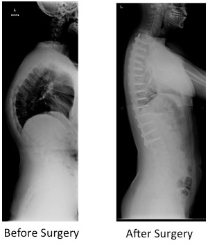 posterior spinal instrumented fusion for scheuermanns kyphosis 1