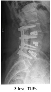 transforaminal lumbar interbody fusion 1