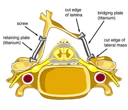 cervical laminoplasty 1