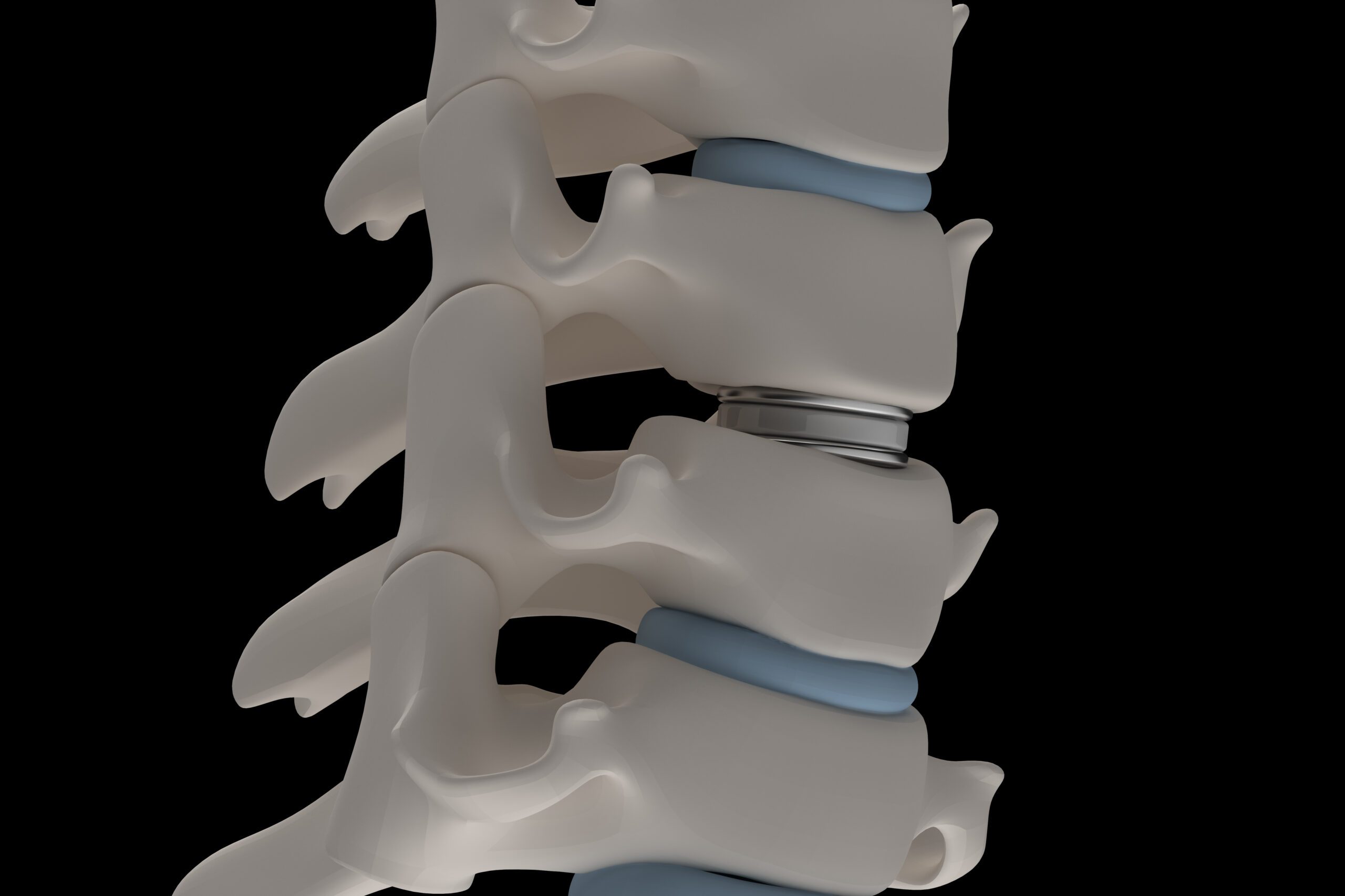 Clevive™ Degenerative Disc Disease Cushion