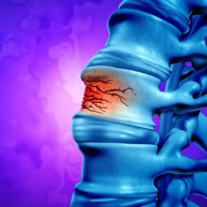 Traumatic,Spine,Fracture,And,Vertebral,Injury,Medical,Concept,As,A Traumatic Spine Fracture and vertebral injury medical concept as a human anatomy spinal column with a broken burst vertebra due to compression or other osteoporosis back disease as a 3D illustration.